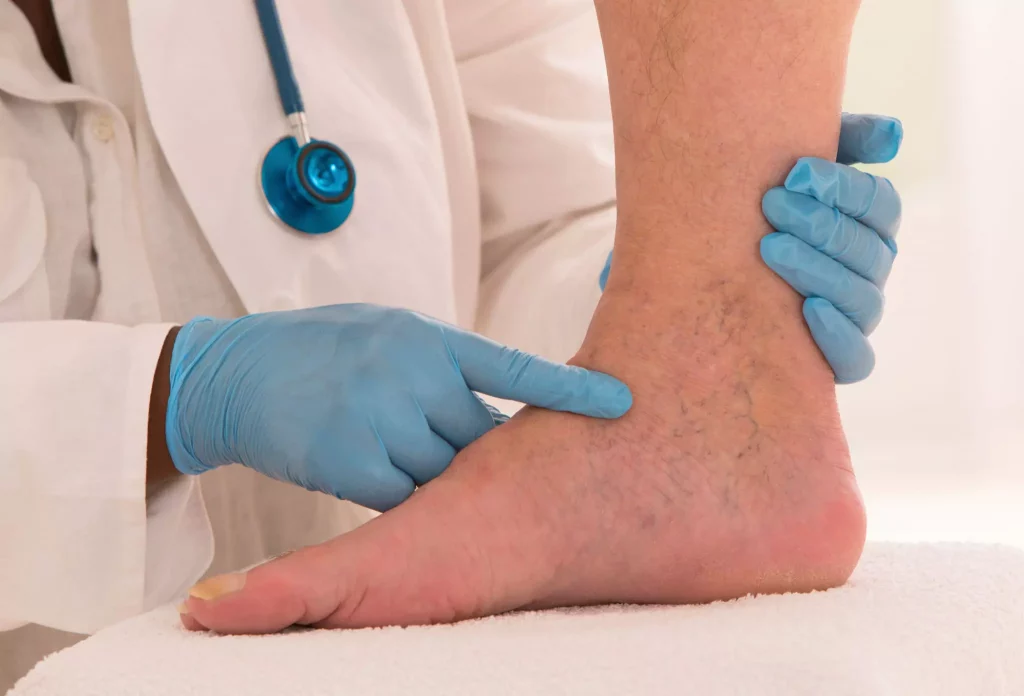 Varicose Veins