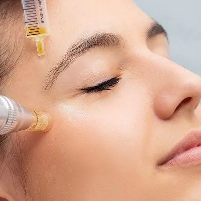 PRP Face Treatment Onsite