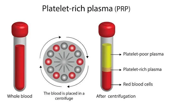 PRF Platelet-Rich Fibrin