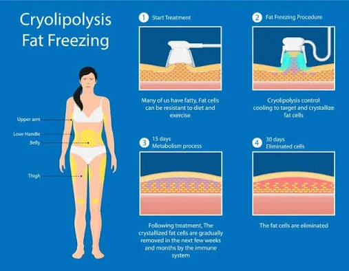 Fat Freezing (Cryolipolysis)