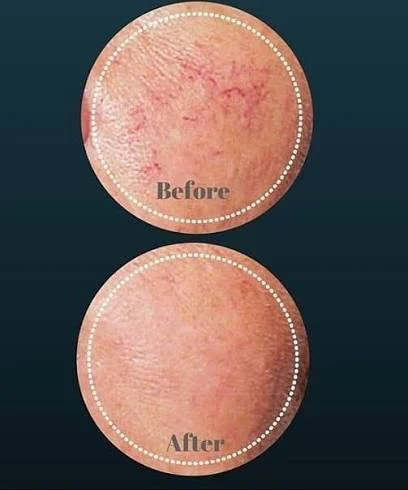 Thread Vein Removal on the Face